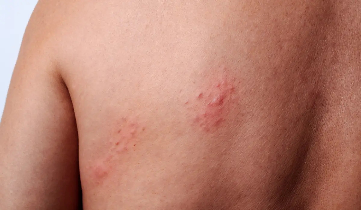 Clustered red welts on upper back skin showing common visual pattern associated with bed bug bites.